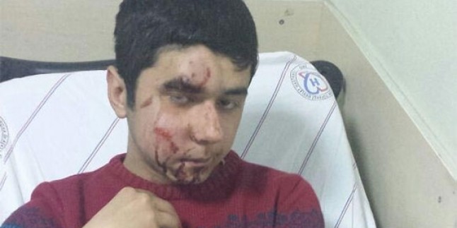 14 Yaşındaki Çocuk, Polisin Attığı Gaz Kapsülü İle Yüzünden Vuruldu…